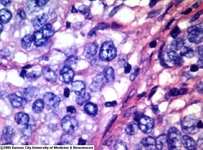 Cancer Cells. Photo via www.pathguy.com